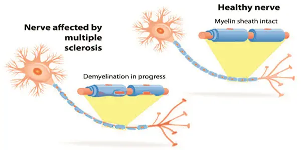 types-of-multiple-sclerosis